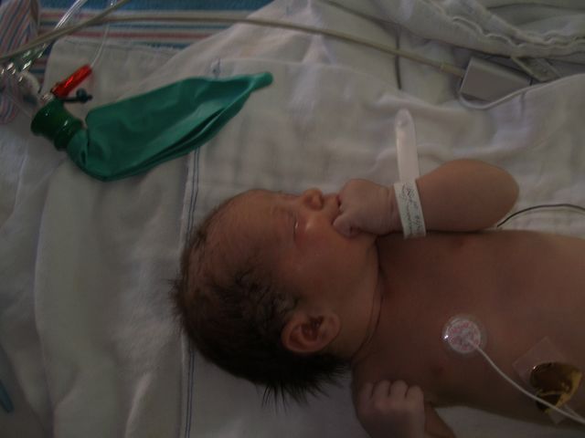 In the NICU after birth