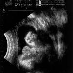 Ultrasound 10/17/02 12 Weeks