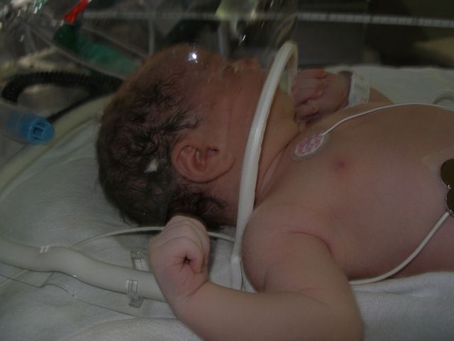 In the NICU after birth, bubble baby
