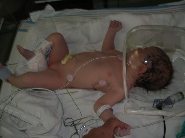 In the NICU after birth, bubble baby