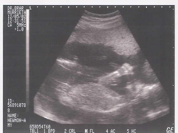 12/5/02 - It's a Girl!!!  18 Weeks, 6 Days!